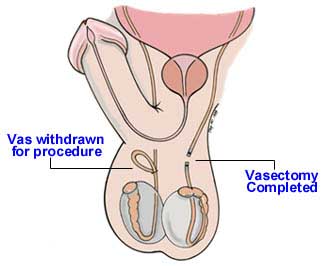 Vasectomy In In Portland Or